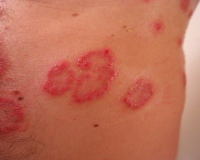 CBD-&Ouml;l zur Behandlung