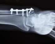 CBD-Studie Knochen Cannabinoide